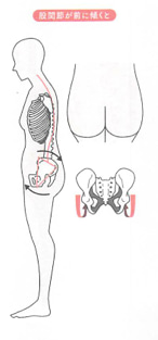 背骨と脚の歪み